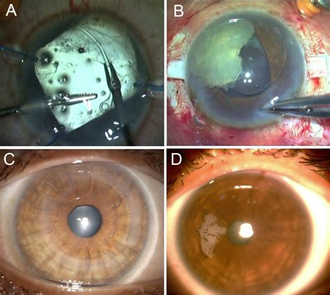 ESCRS - Complications of cataract and refractive surgery