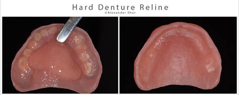 What is Denture Reline? - Shor Dental Blog Seattle