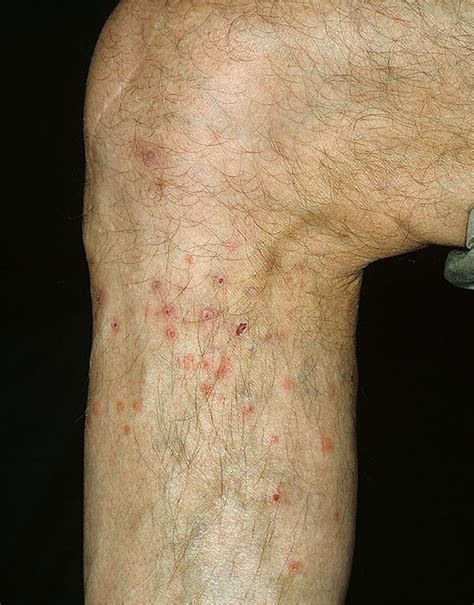 Flea Bites on Humans - Pictures, Symptoms and Treatment