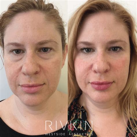 Non Surgical Facelift - RIVKIN Aesthetics