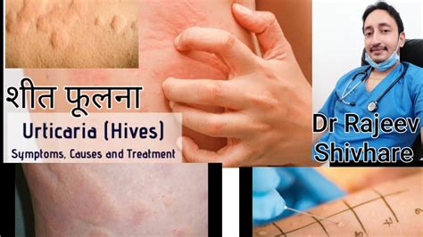 URTICARIA, शीत फूलना, skin allergy, angioedema , food allergies, allergy testing , #Dr.Rajeev ...