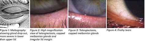 How to manage patients with Meibomian Gland Dysfunction (MGD)