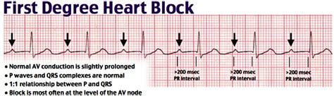 Heart block causes, symptoms, types, diagnosis and heart block treatment