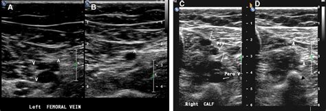 Duplex Ultrasound in the Diagnosis of Lower-Extremity Deep Venous ...