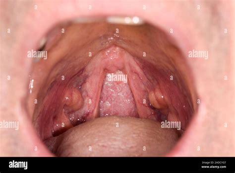 Tonsillar cysts in the throat of a 68-year-old man. Tonsils are oval ...