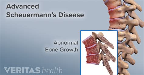 Scheuermann's Disease of the Thoracic and Lumbar Spine