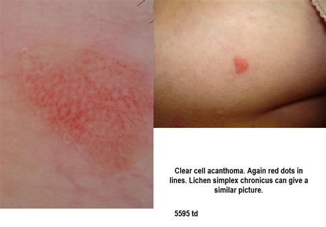 Dermoscopy Made Simple: Clear Cell Acanthoma