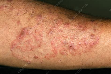 Majocchi's granuloma - Stock Image - C056/6159 - Science Photo Library