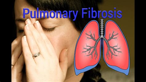 Pulmonary Fibrosis Clinical Presentation( English) - YouTube