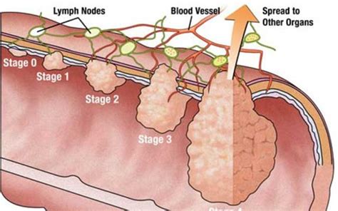 What Does A Vulvar Cancer Lump Look Like - slideshare