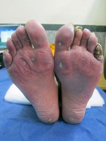 Feet Problems And Scleroderma