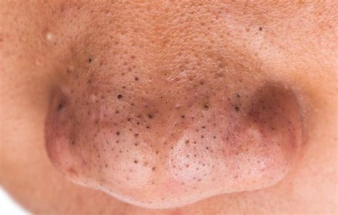 How to Get Rid of Blackheads on Your Nose | Men’s Health