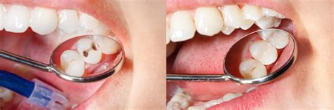 how do composite fillings work - Ilana Ponce