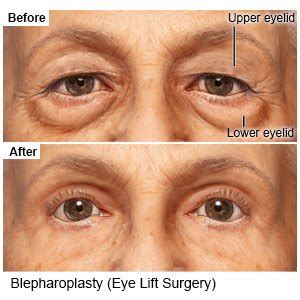 Eye Lift - What You Need to Know