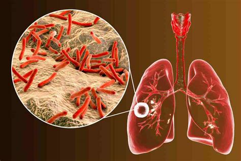 Mycobacterium Tuberculosis Merupakan Bakteri Penyebab Penyakit - Homecare24