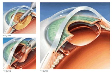 Phacoemulsification Surgery for Cataract-Shekar Eye Hospital