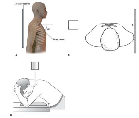 Sternoclavicular Joint Injuries | Obgyn Key