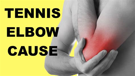 Tennis Elbow Causes & Test (Lateral Epicondylitis) — The Pain Free Institute