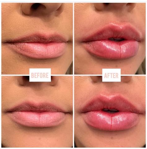 Lips by @lina_sev_ 1 Full Syringe of Juvederm Ultra XC Currently Taking ...