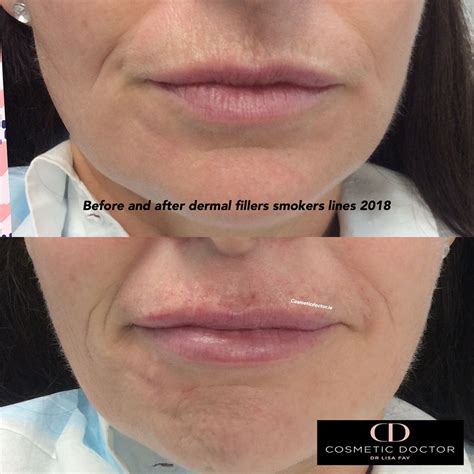 Smokers Lips Before And After | Lipstutorial.org