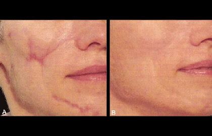 10 things you should know before having laser scar treatment - Dermatologist in Pittsburgh, PA ...