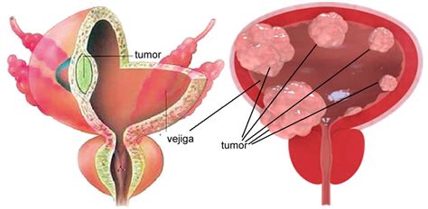 Cáncer de Vejiga