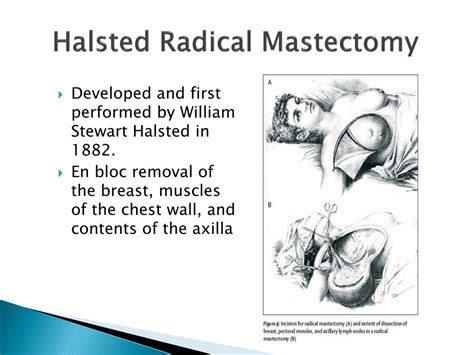 PPT - From Radical Mastectomy to Partial Breast Irradiation: The ...