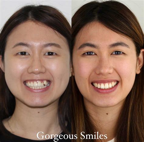 Braces Before And After Pictures - Gorgeous Smiles