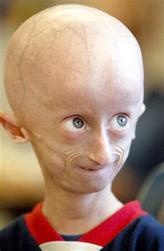 Progeria - Top 10 Worst and Dangerous Incurable Diseases in the world