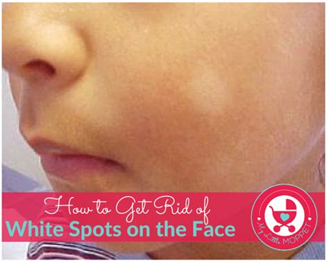 How to get rid of white spots on the face-5 Most Effective Solutions | White skin patches, White ...