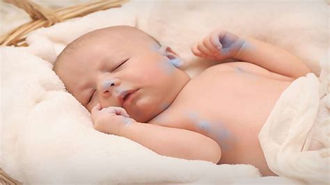 Blue Baby Syndrome: Causes, Symptoms, Treatment And Prevention ...