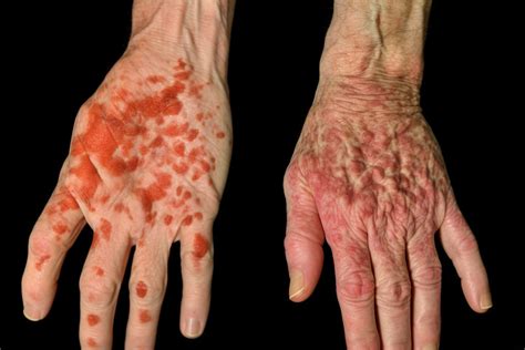 Psoriasis vs Eczema: Differences, Similarities, Treatments by Leo Hayes