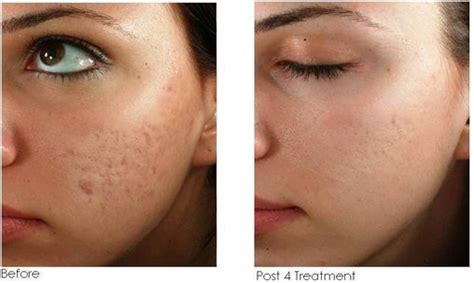 Will Microneedling Reduce Pore Size? - Facial Adviser