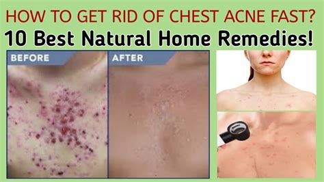 HOW TO GET RID OF CHEST ACNE FAST? 10 Best Natural Home Remedies! ACNE ...