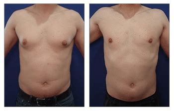 cheapest gynecomastia surgery near me - Casie Roland