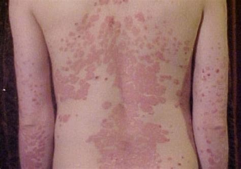 What Is Psoriasis? - Organic Health Solutions