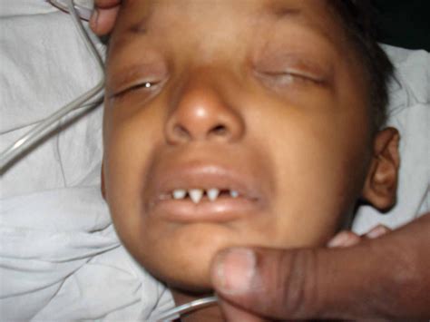 Ectodermal Dysplasia Teeth