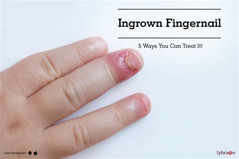 Ingrown Fingernail - 5 Ways You Can Treat It! - By Dr. Sruthi Gondi | Lybrate