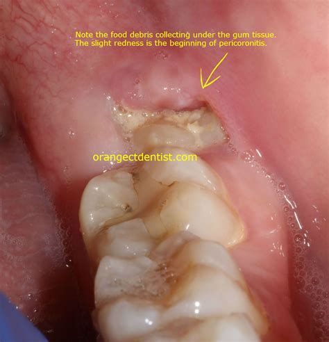 Hole In Mouth After Wisdom Tooth Extraction at Yvonne Lowe blog