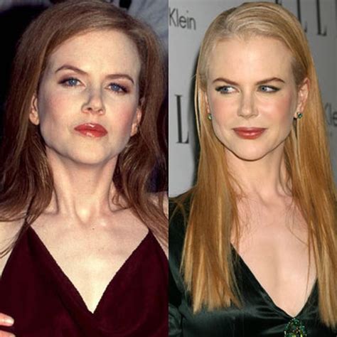 Nicole Kidman Plastic Surgery 2024 - Kanya Juline