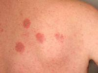 Nummular dermatitis images | DermNet New Zealand