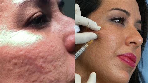 POCK MARKS: Dr. Sandra Lee tests out a new treatment that can help ...