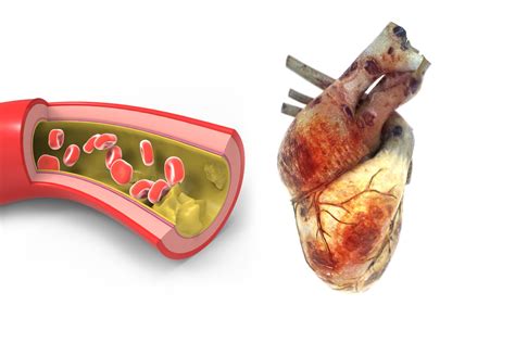 The Link Between Diabetes and Heart Disease - Alternative Medicine Magazine