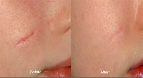 Acne and Surgical Scars Removal Orlando, FL