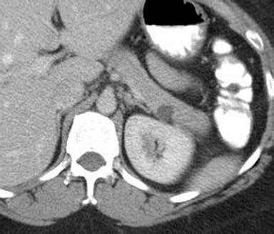 Pancreatic Cyst Aspirate CEA Levels: Two's the Charm | Nasr | JOP ...