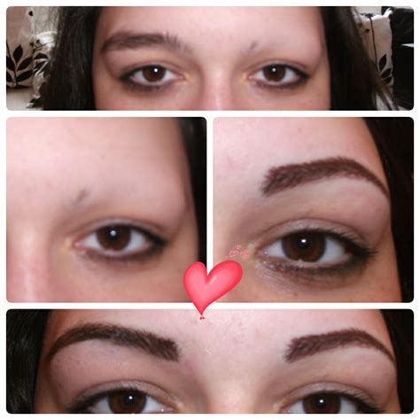 alopecia eyebrows before & after - Redeem Clinic