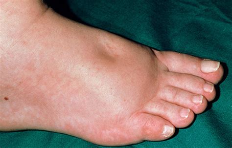 Causes Of Swollen Ankles In Diabetics - DiabetesWalls