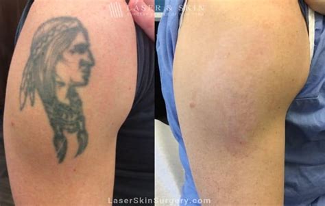 Breaking up With Your Tattoo: Why Laser Tattoo Removal Treatments Are ...