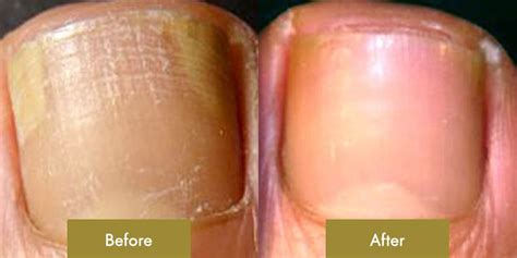 Onychomycosis – Nail fungal infection | Dermatology Clinic Dermadvance