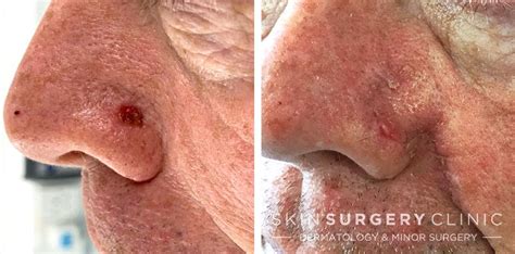 Basal Cell Carcinoma BCC Skin Cancer Removal Leeds Bradford Before and ...